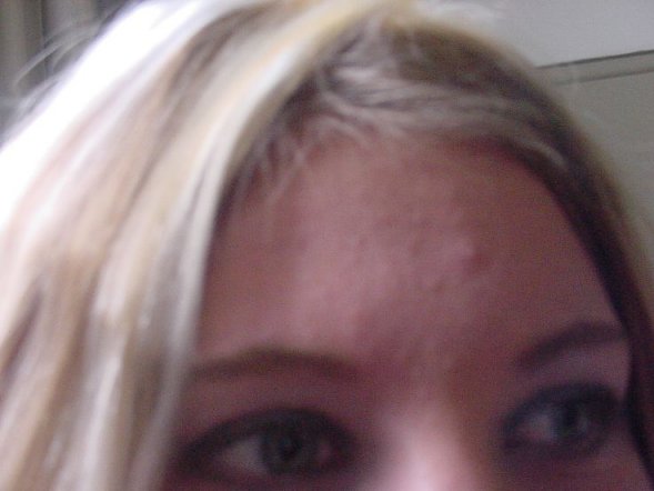 Lav's Pimple...haha